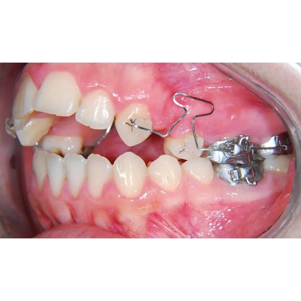 OrthoMetric Advanced Bonding Tubes Kit MBT 022 - 200 Units (20.12.2146)