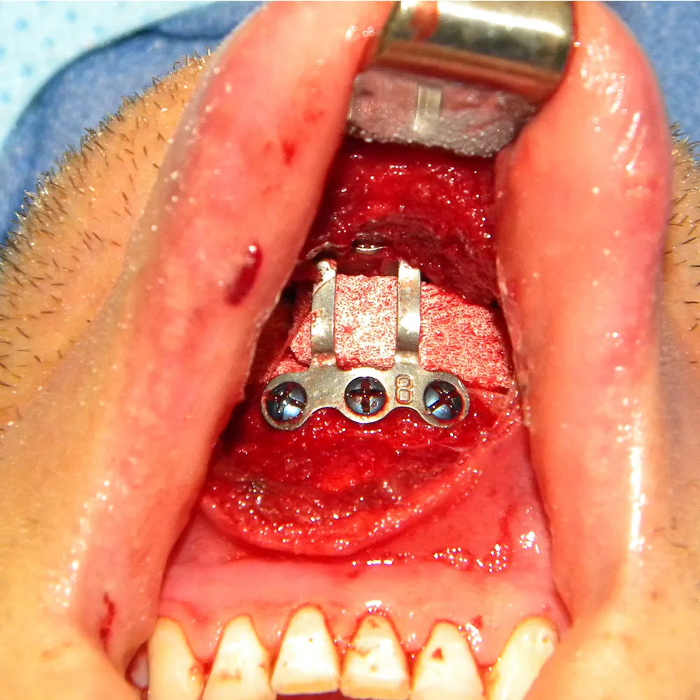 SK Surgicals Titanium Mini Chin Plates 2mm