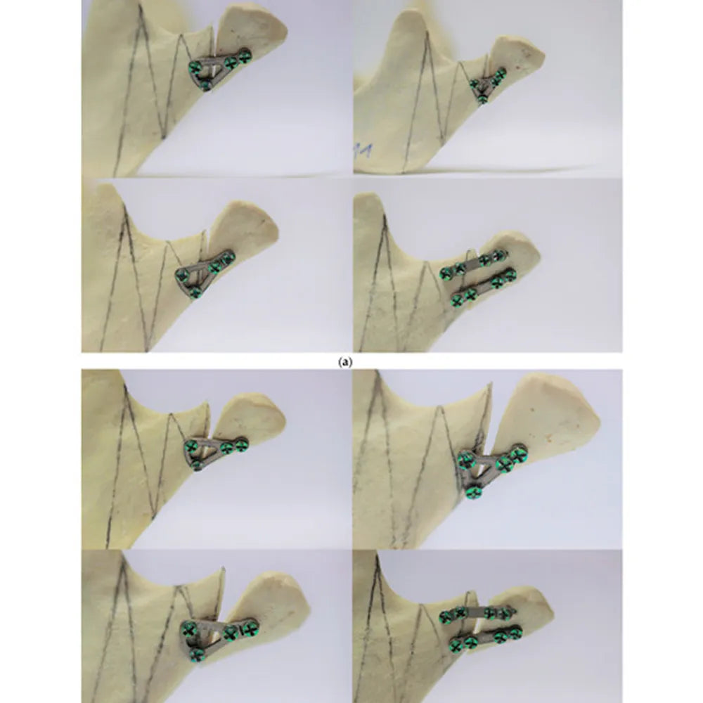 SK Surgicals SS Mini Bone Delta Plates - 2mm ( 300.501S)