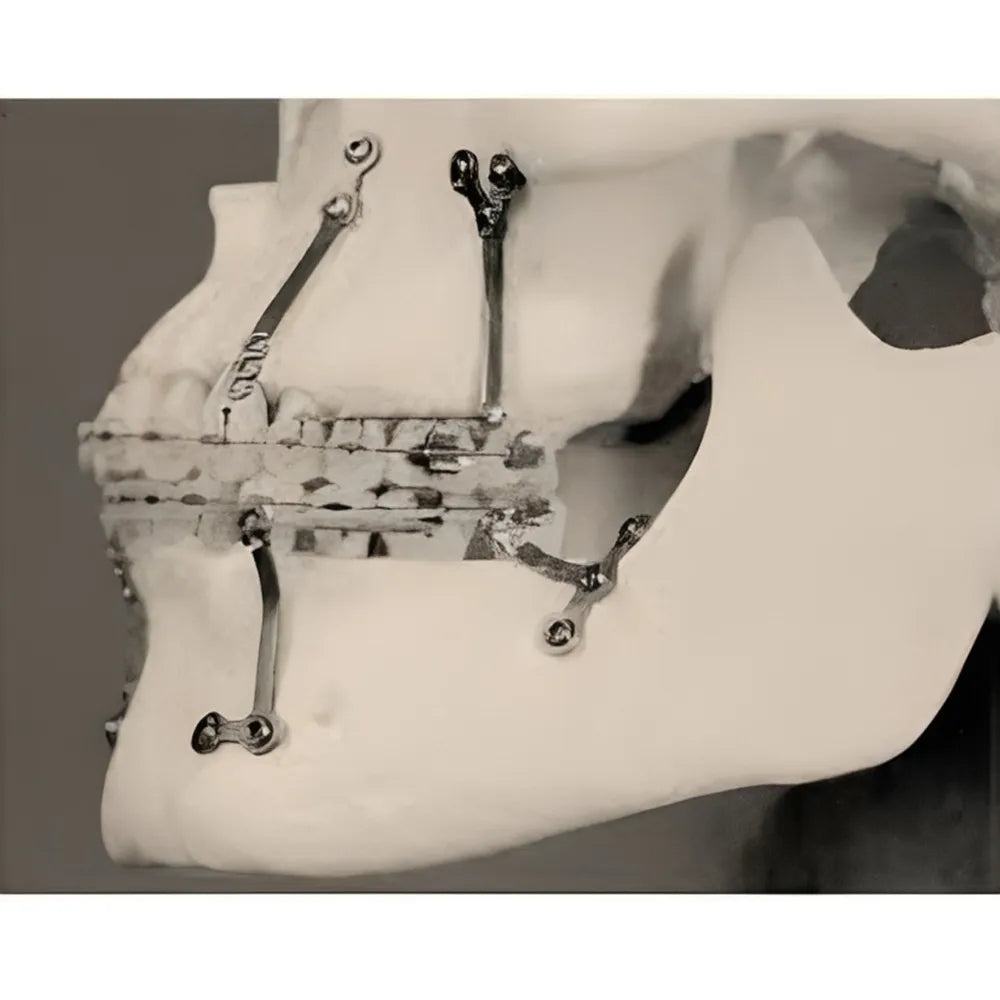 SK Surgicals Orthodontic Titanium Mini Anchorage Plate T Shape - 2mm