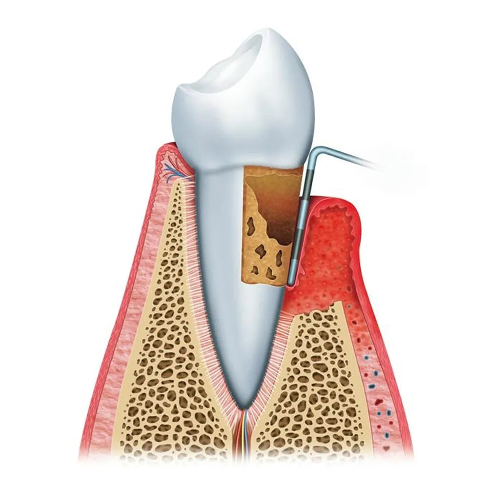 GDC Double End Probes Cp12 / Screening Probe #6 (Pcp12/11.5b)