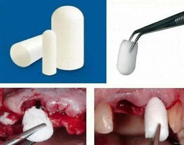 Cologenesis ColoPlug Sterile Collagen Sponge - Pack of 1