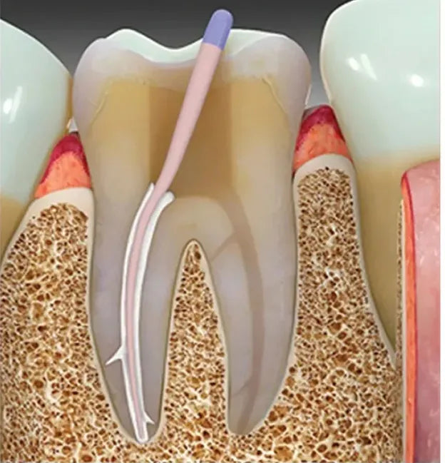 Sybron Endo Sealapex Root Canal Sealer