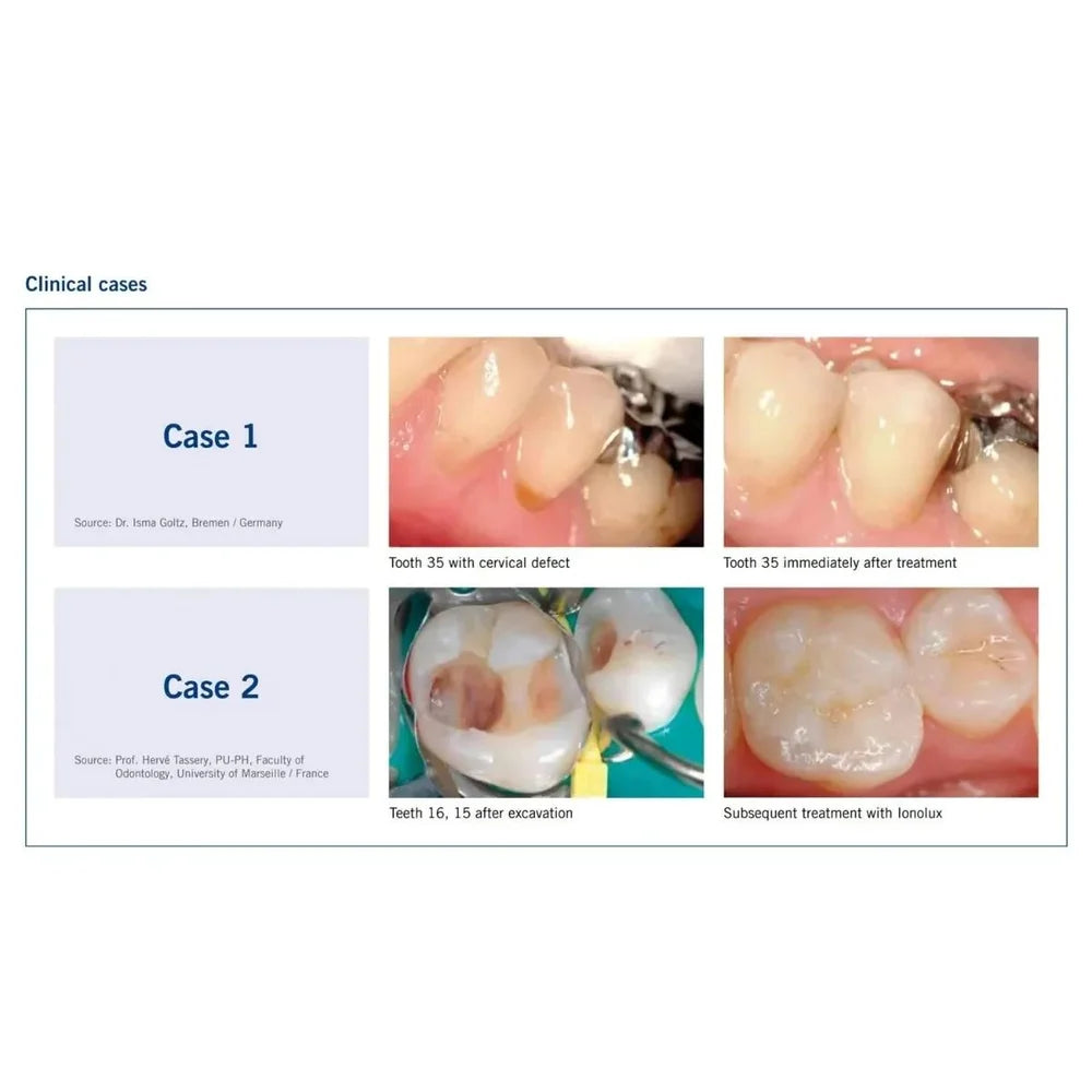 Voco Ionolux Glass Ionomer Restorative Cement