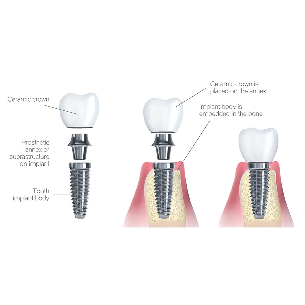 Xcem XE Submerged Dental Implant 5.5mm