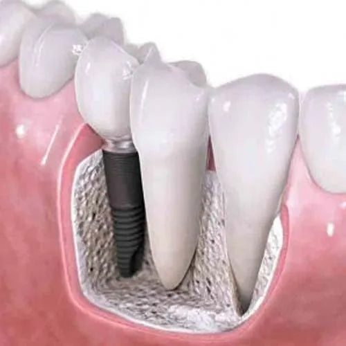Xcem Solo Dental Implant
