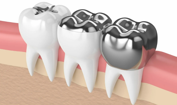Amalgam