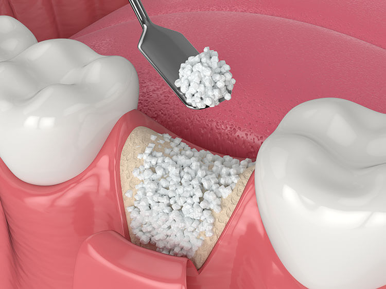 Bone Grafts and Membranes