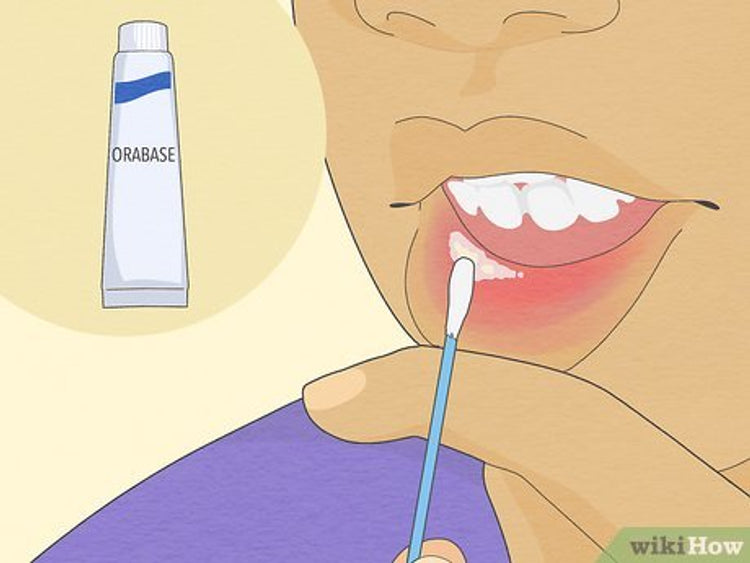 Stim Ultigel Oral Ulcer Gel Local Anaesthetic