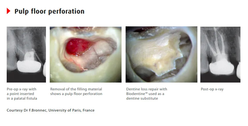 Septodont Biodentine(Single Pouch)