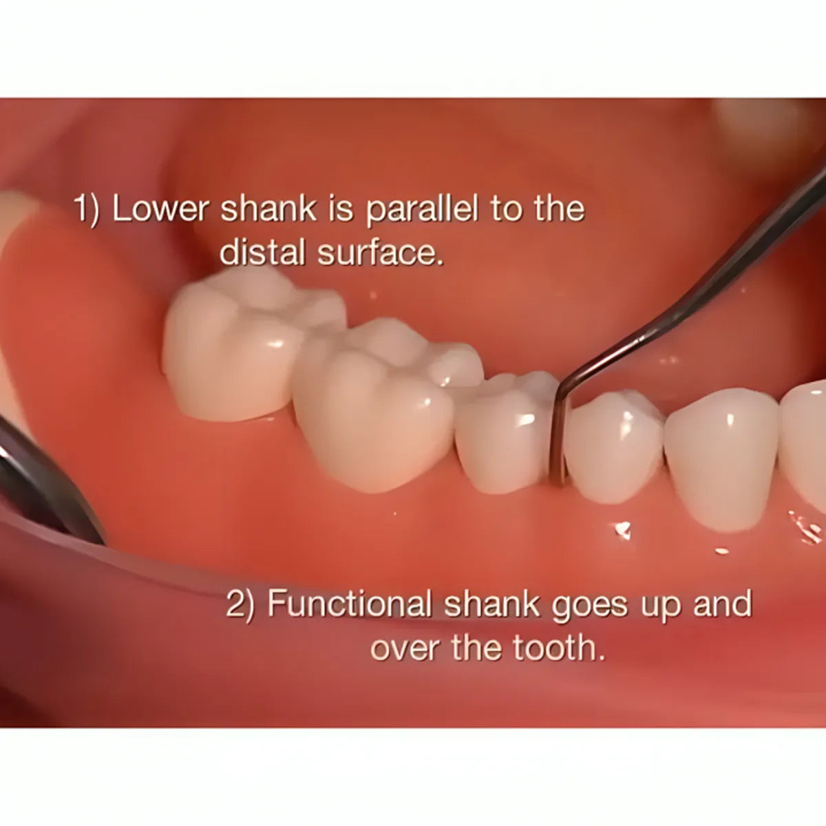 GDC Furcation Curette Quetin - Buccal/lingual # 6 (SQBL2 # 6)