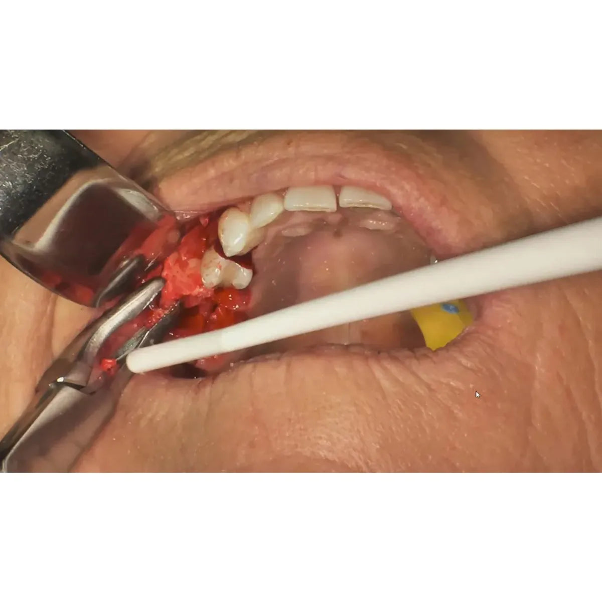 GDC Bone Rongeurs Blumenthal 45 Degree - 14.5cm (RBL45)