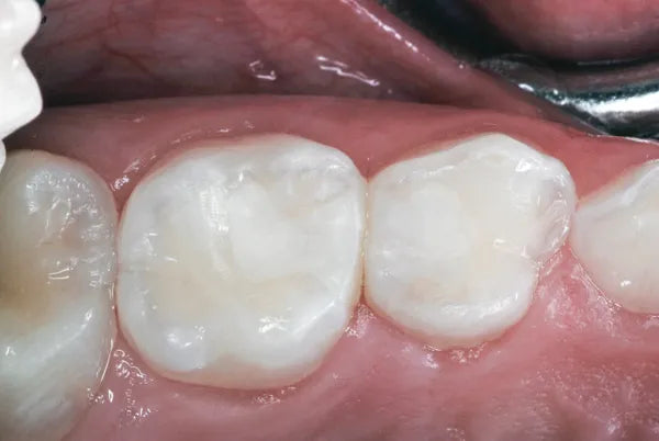 DentGist Bio Glass Gold Restorative GIC (Big Pack)