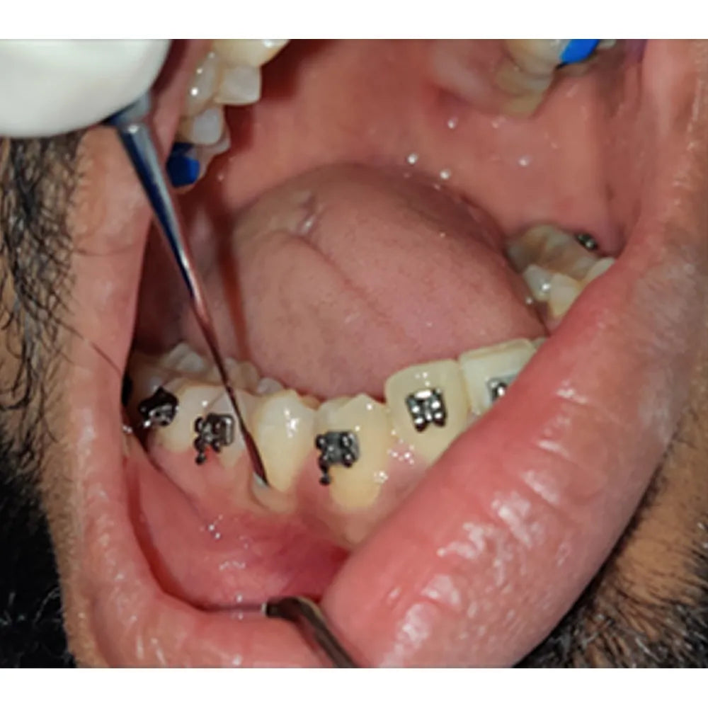 GDC Periotome #4 (P1)