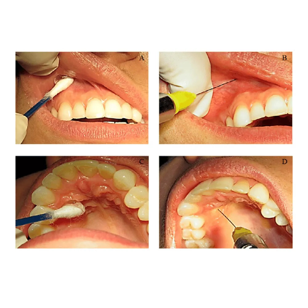 Pascal Precaine Topical Anesthetic Gel 30 Gms