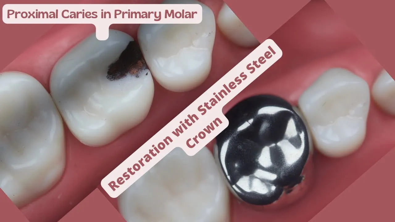 3M Espe SS Crown Primary Molar Crown-D (1st molar)