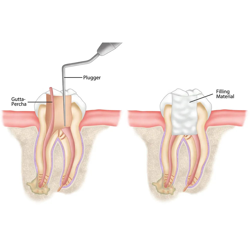 GDC Rc Plugger Luks (Cc) -7 (.25mm) (Rcplcc1)