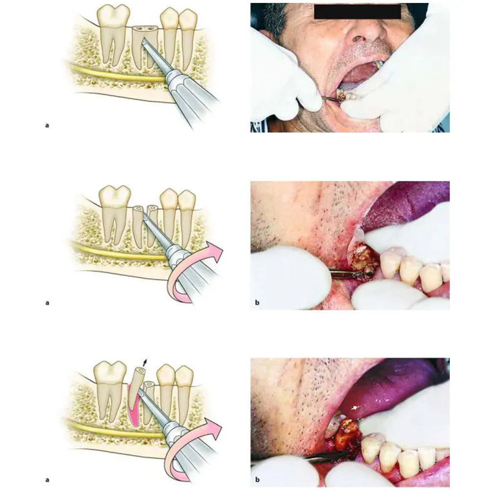 GDC Root Elevators London Hospital Premium (E20hp)