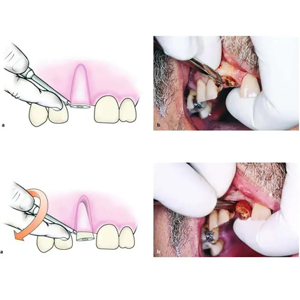 GDC Root Elevators Coupland Premium (Ea1cp)