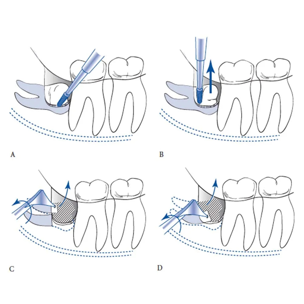 GDC Oral Surgery Impaction Kit (OSIP22)