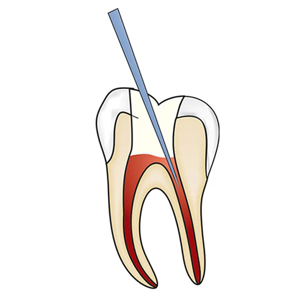 GDC Endo Explorer DG 16 - 6 (EXDG16)