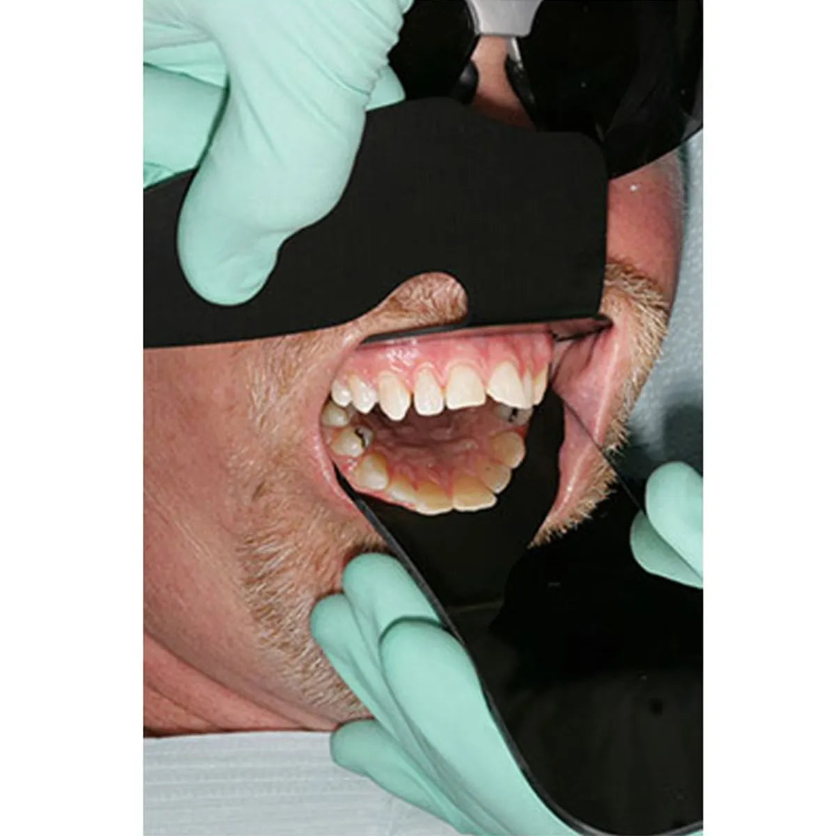 LD Plastic Contrastors Set - LD-004