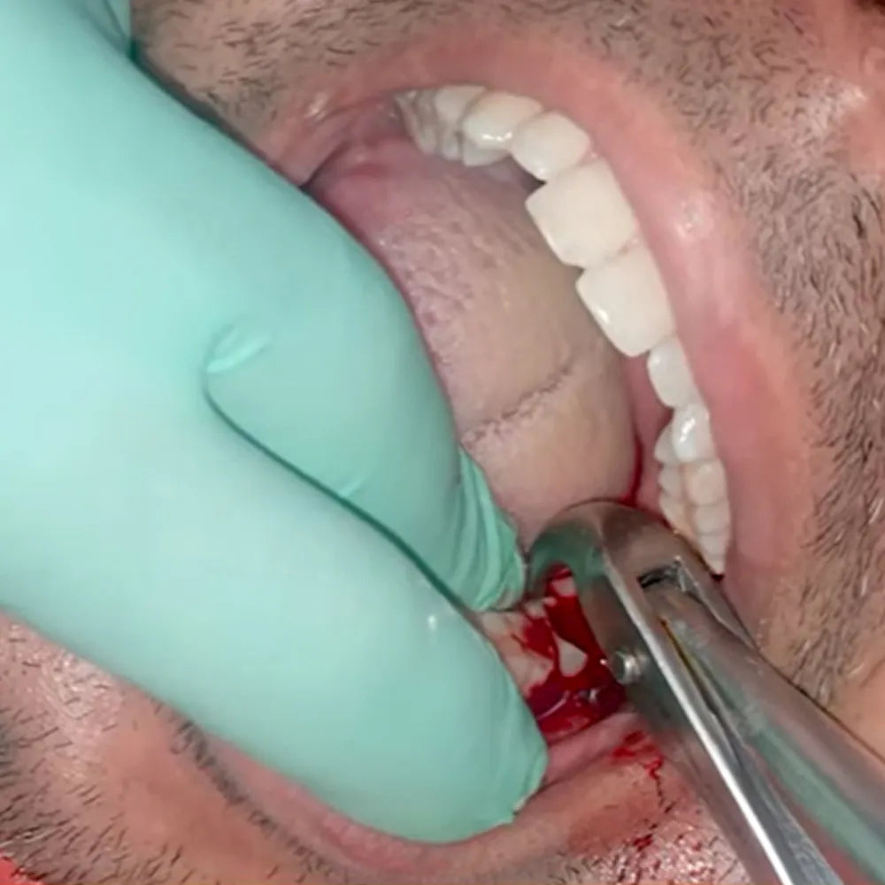 GDC Extraction Forceps Lower Molars - 22 Standard (FX22S)