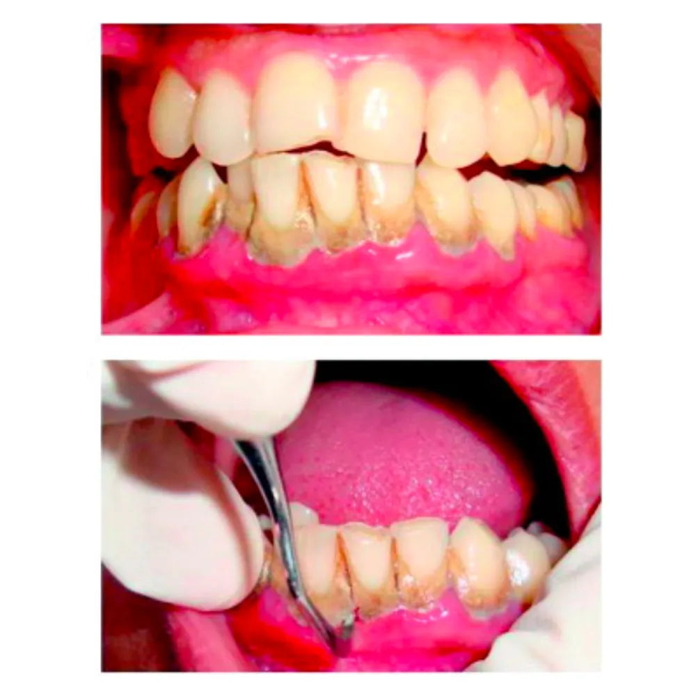 GDC Gracey Curettes #6 (Sg13/14)