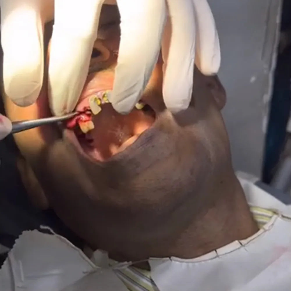 GDC Root Elevators Coupland Premium (Ea1cp)