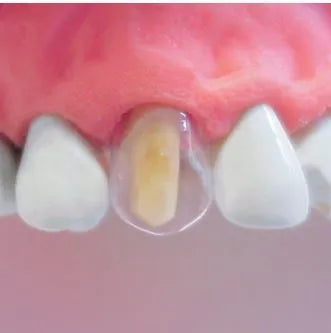 Tor VM Transparent Crowns 64 pcs- Deciduous No 1.912