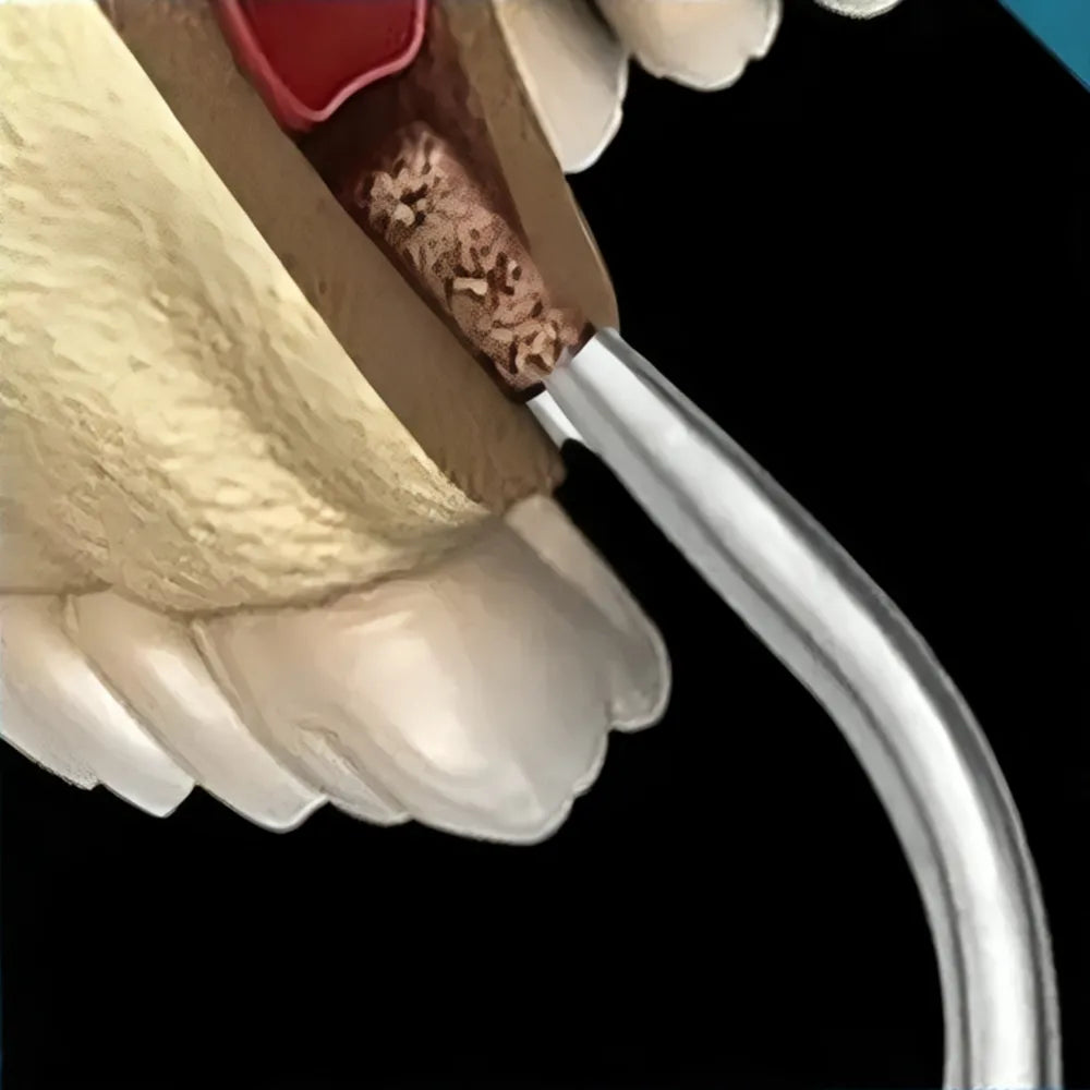 GDC Bone Collector Filter (7mm) (Bc1331/1f)