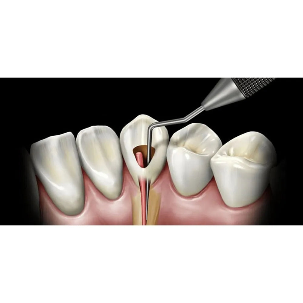 GDC Rc Plugger Luks (Cc) -7 (.25mm) (Rcplcc1)