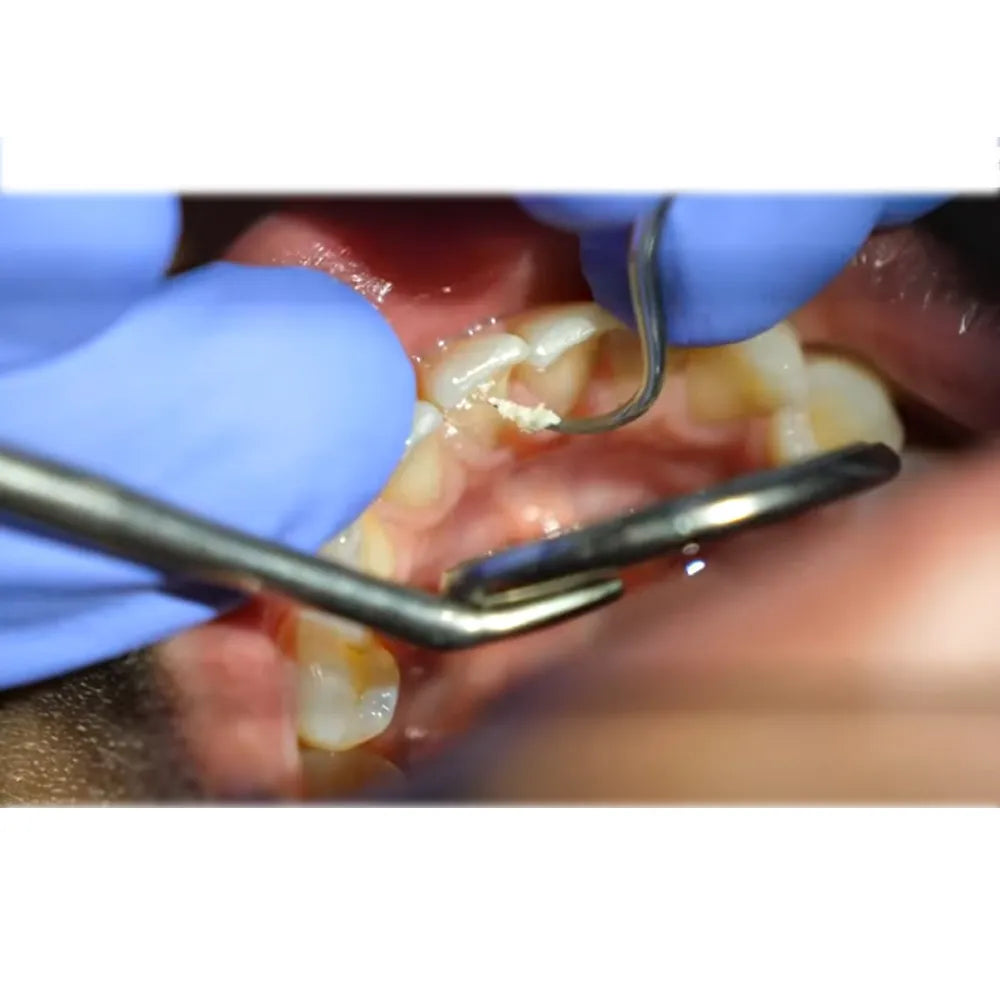 GDC Sickle Scalers Anterior #6 (Scnevi1)