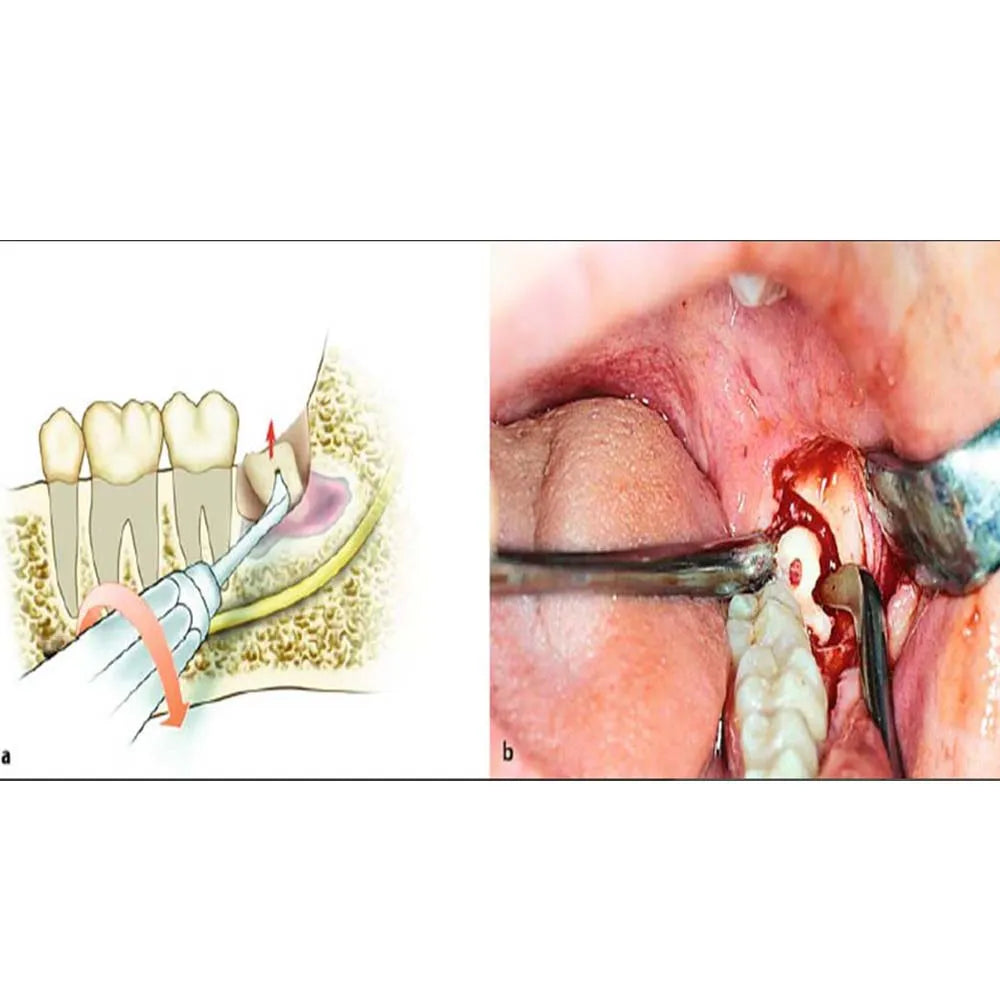 GDC Oral Surgery Impaction Kit (OSIP22)