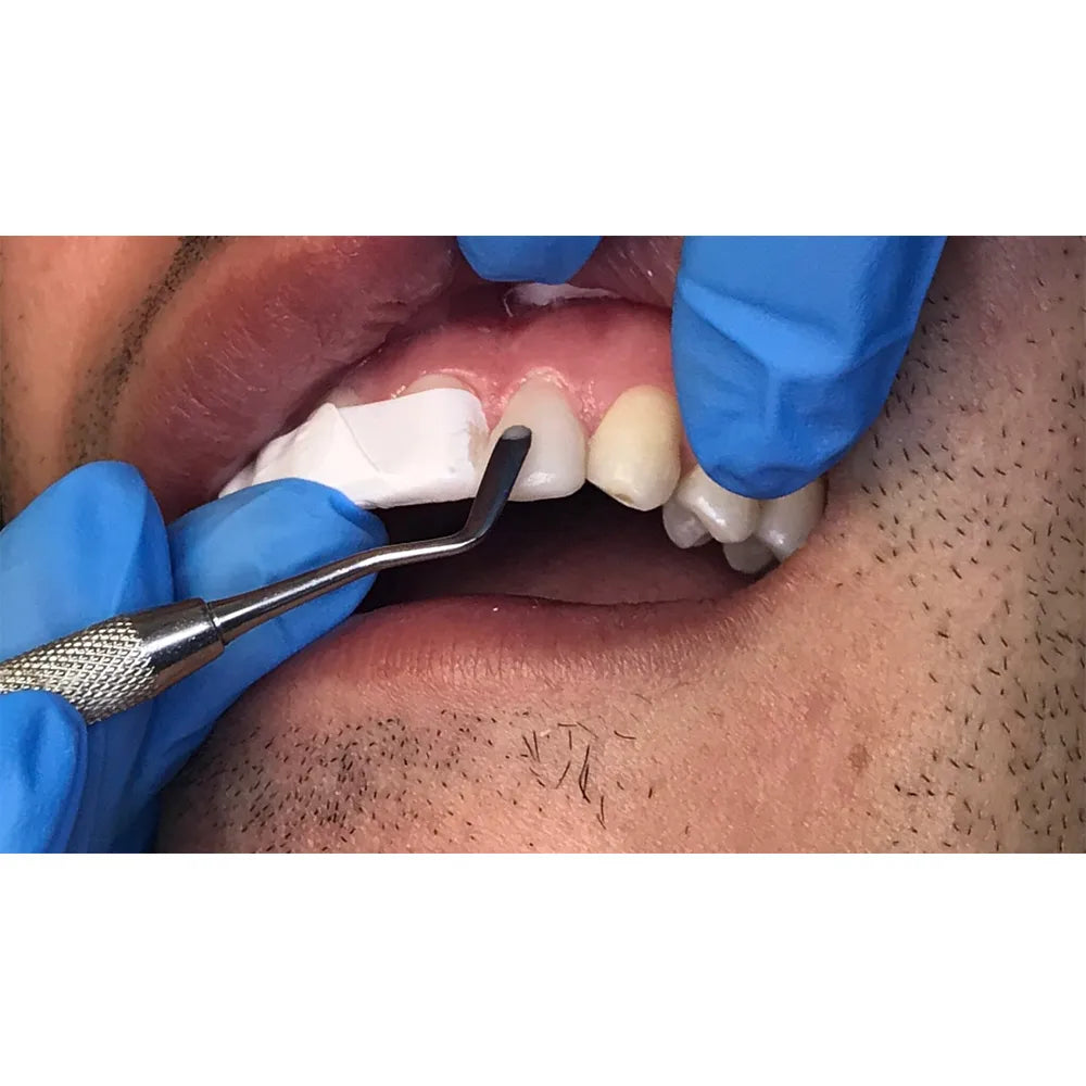 GDC Plastic Filling Instrument - 4 (PF21)