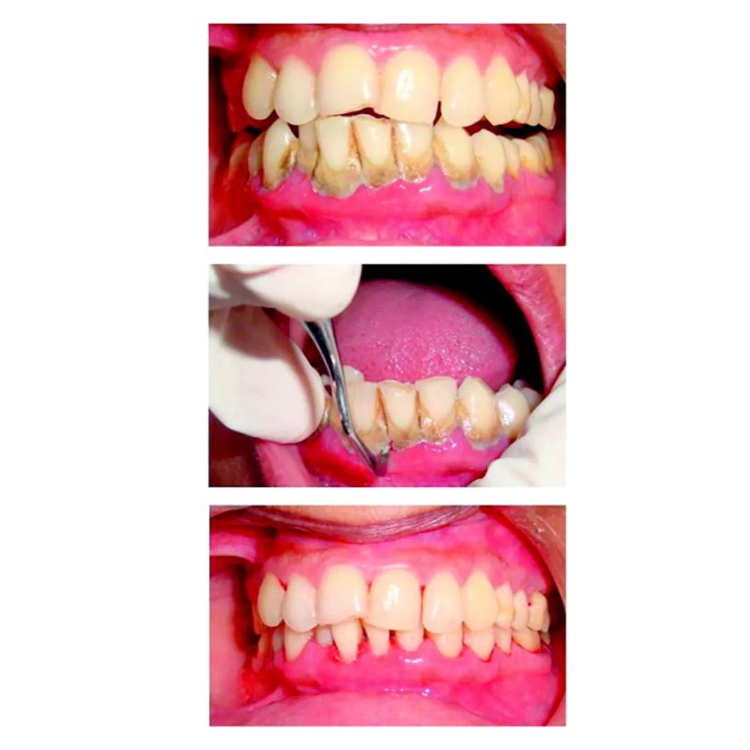 GDC Columbia Curettes 2r/2l Anterior Application #6 (Sc2r/2l)