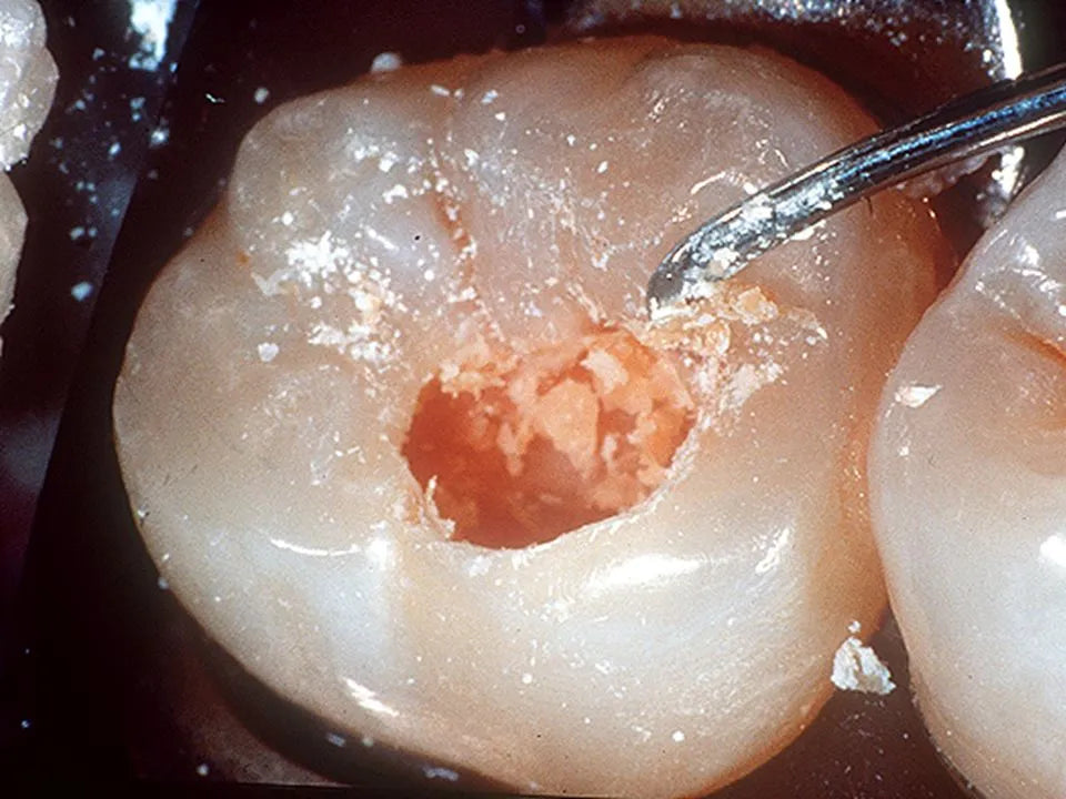 GDC Darby-Perry Spoon Excavator - 6 (Exc153/154)