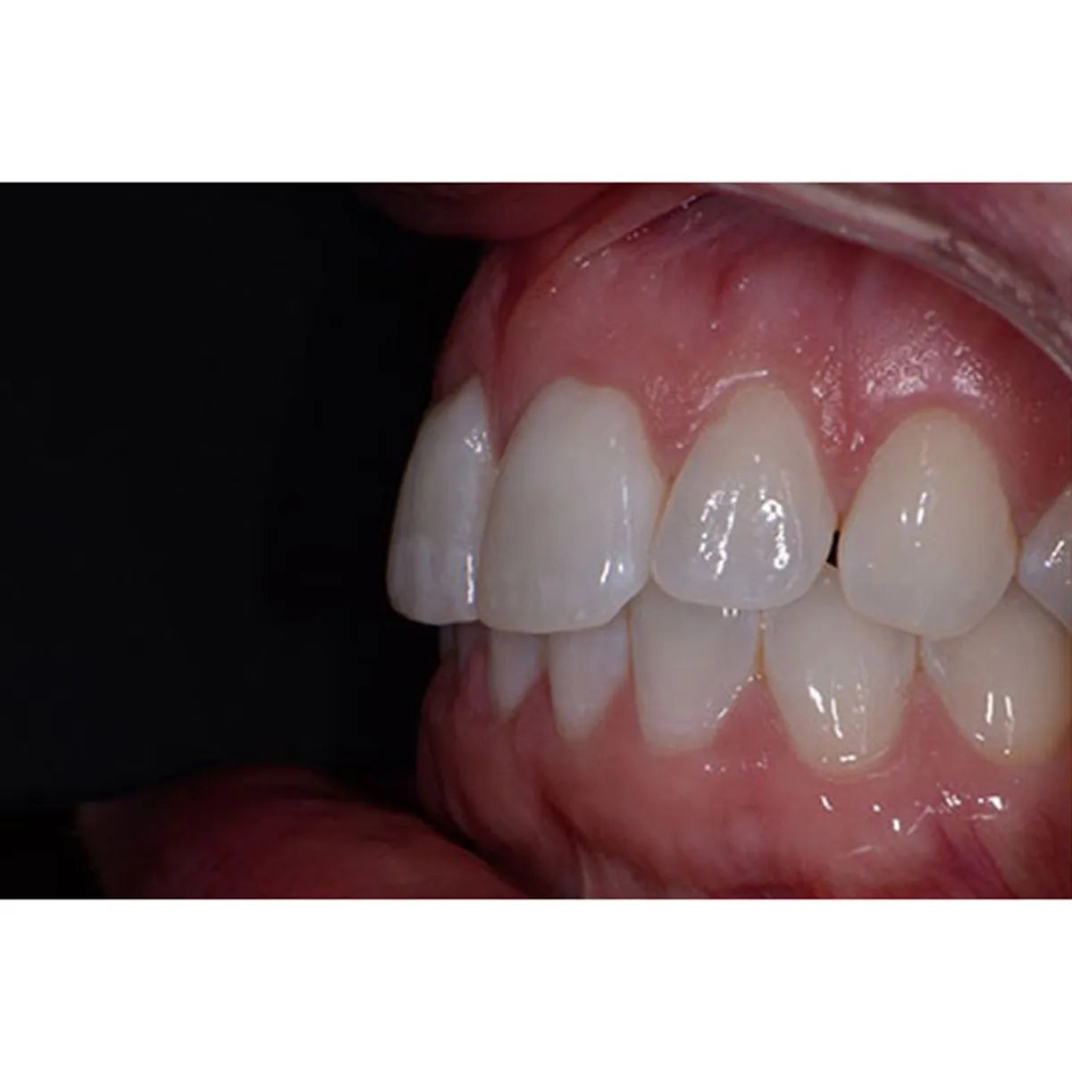 LD Plastic Contrastors Set - LD-004