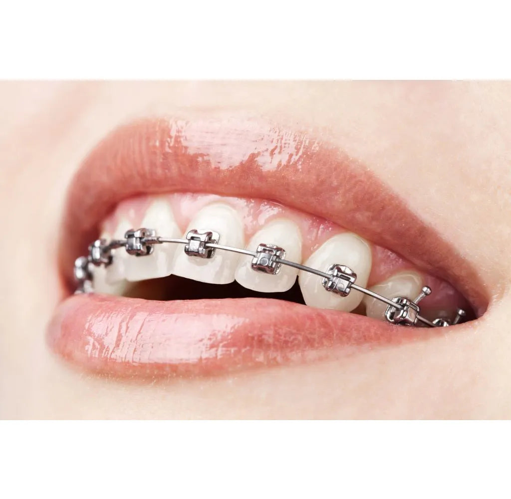 ET Dental MBT 022 Mini Brackets Kit (Non-Extraction)