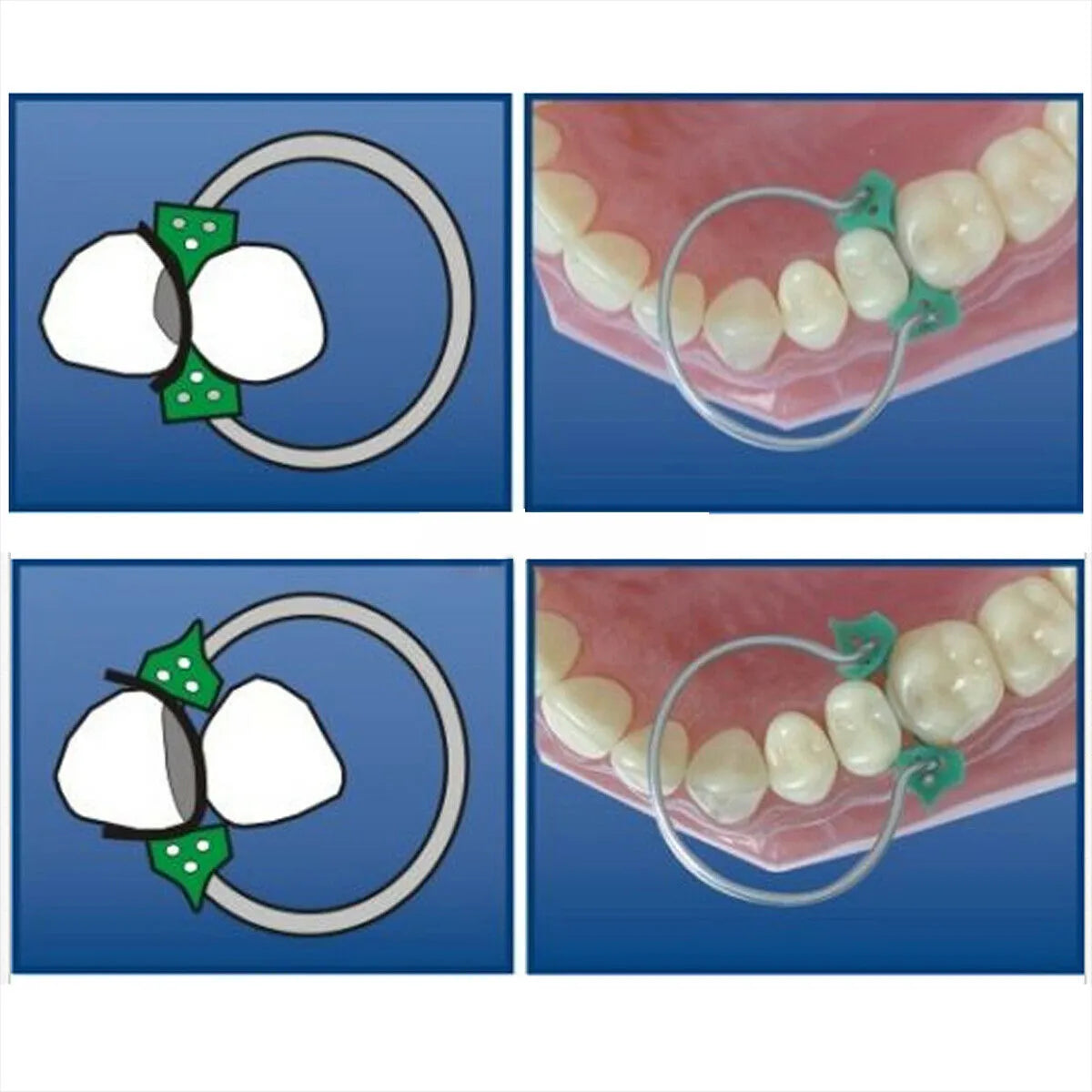 ET Dental Silicone Wedges