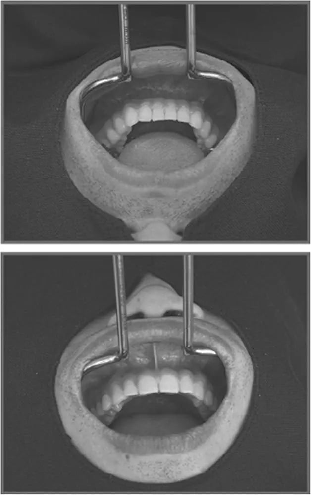 GDC Retractors Vestibulum 14cm (CRV)