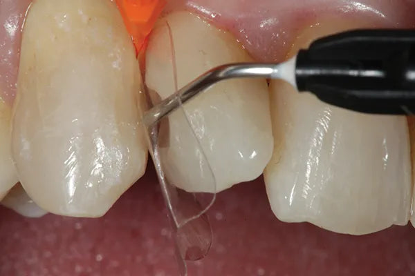 Prevest Denpro Fusion Flo SE Trial Pack (20008-3)