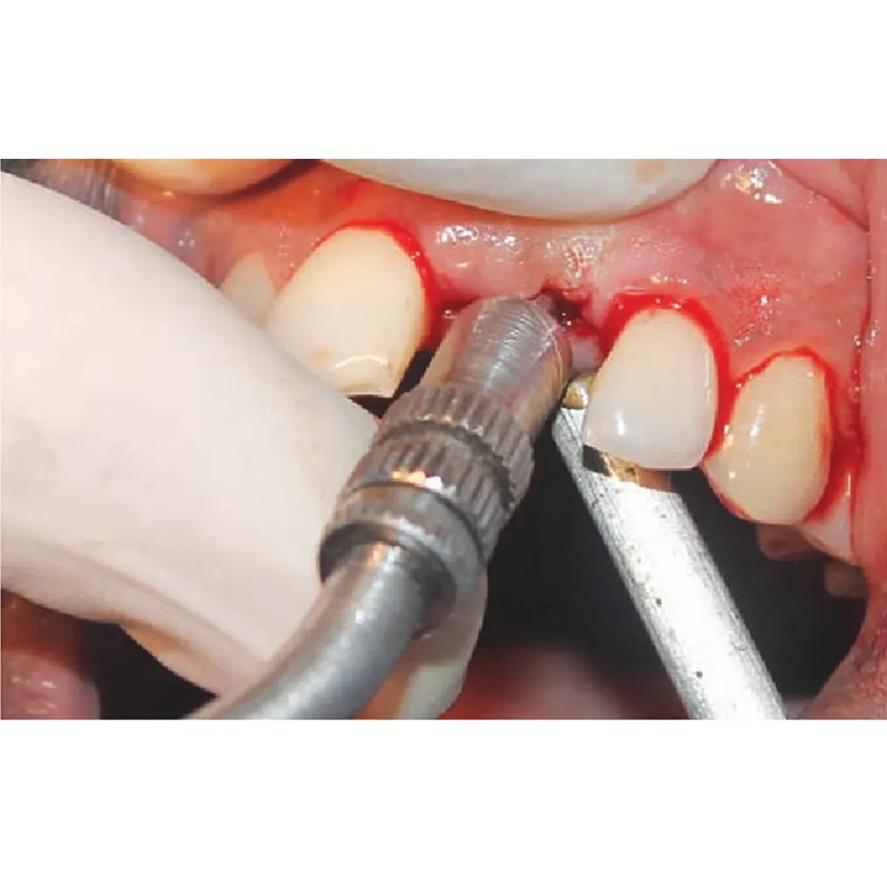 GDC Osteotome Concave Angulated Set Of 6 In Cassette (Ostmshawc6)