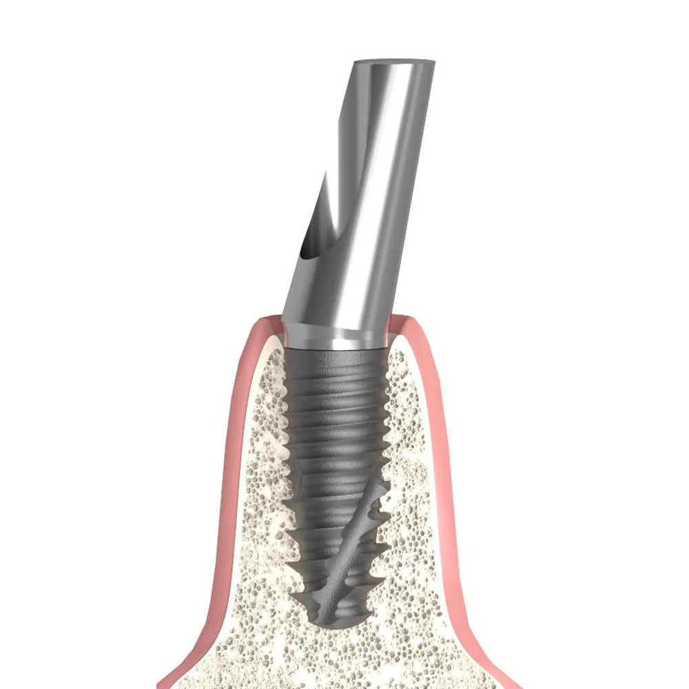 Adin CloseFit Dental Implants