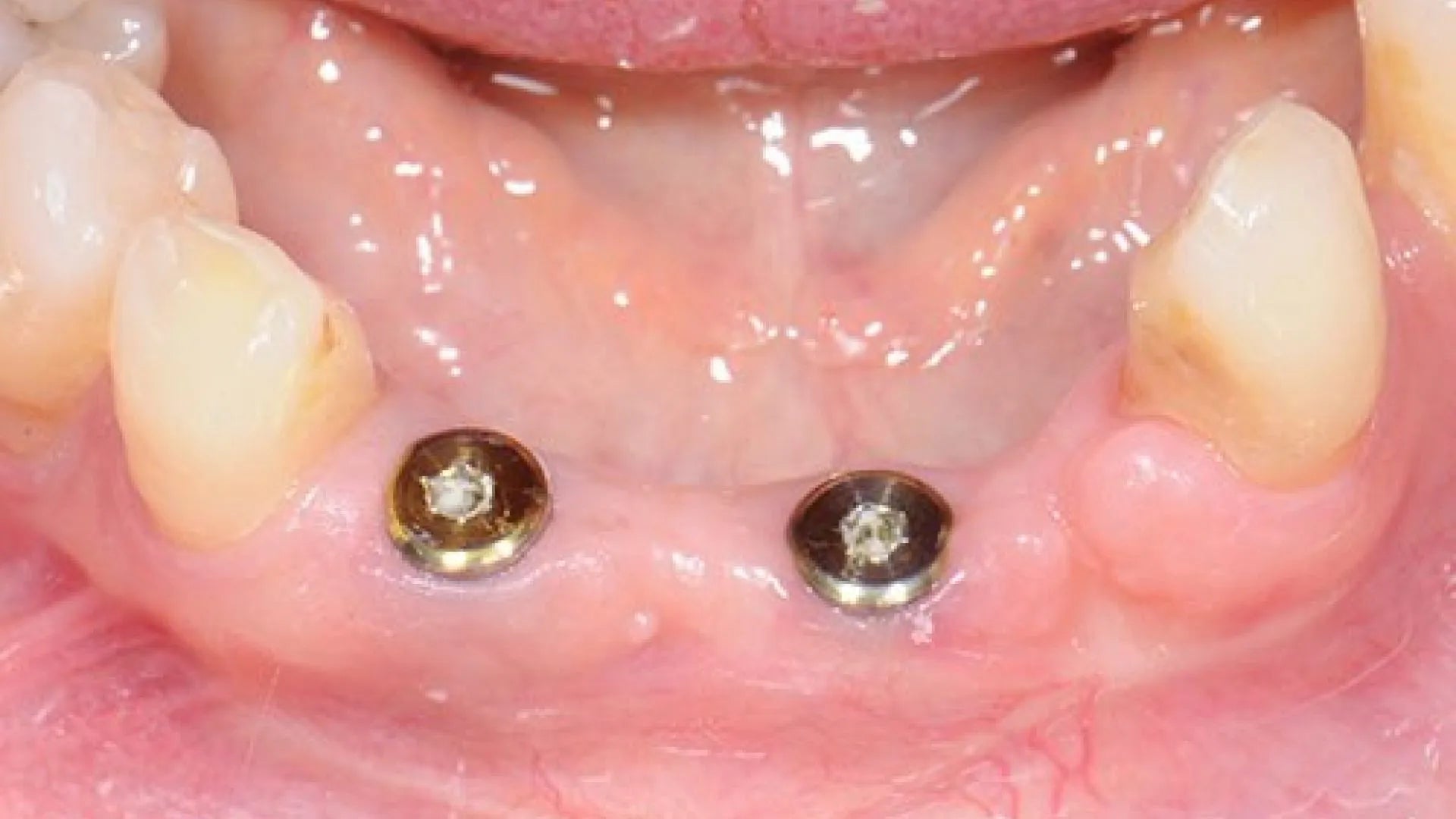 Adin RS Flat Connection Abutment