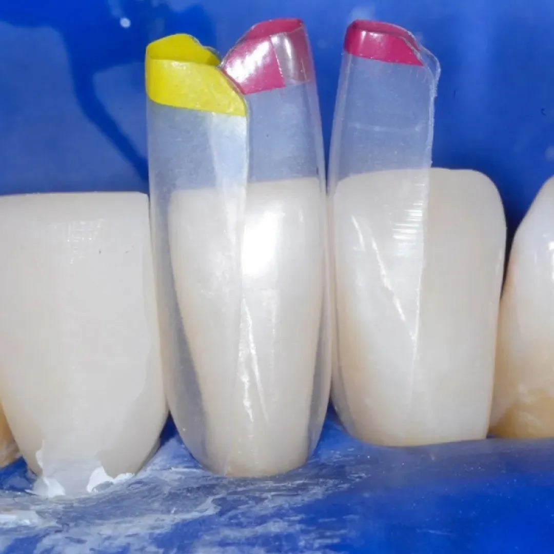 Buy Bioclear Black Triangle Procedure Matrix System Kit – Oralkart