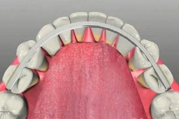 DentAct Fiber Splint 14cm