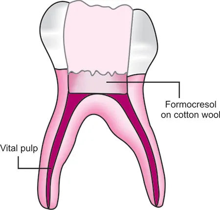 DentGist Buckley's Formocresol