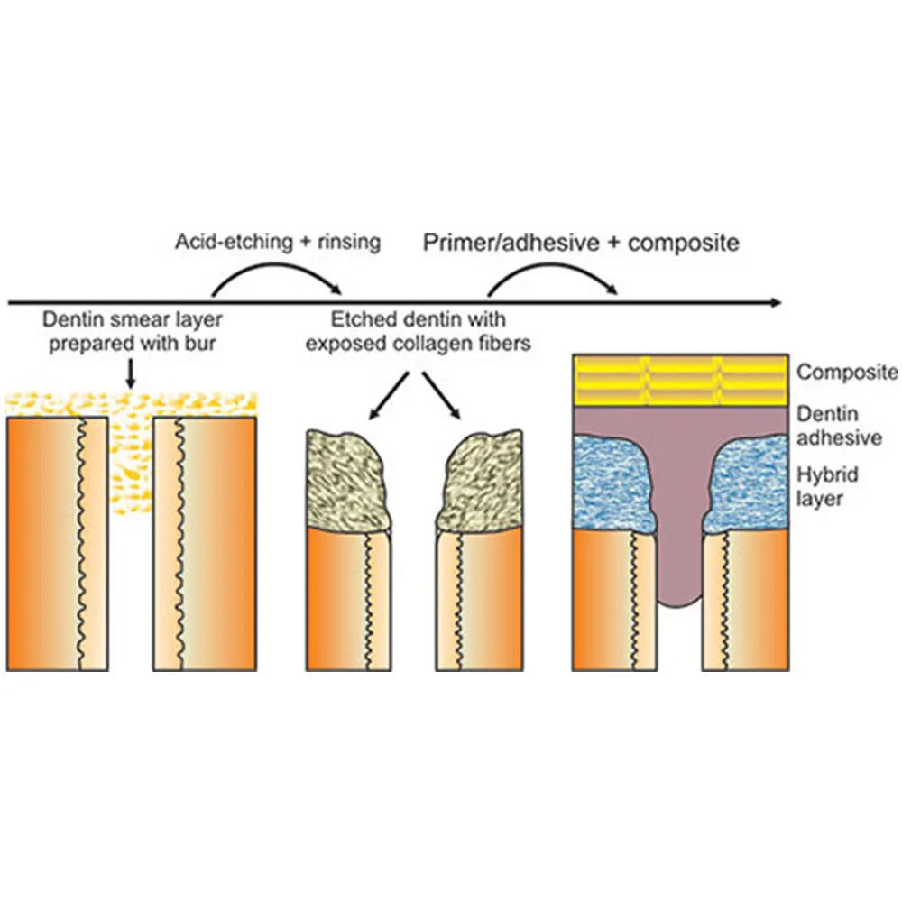 DentGist Nano-Bond (5th Gen Bonding Agent)