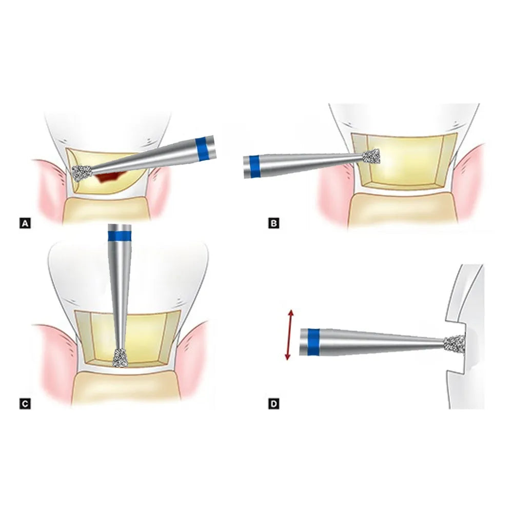 Frank Dental Cavity Preparation Bur -Straight Inverted Cone SI-48